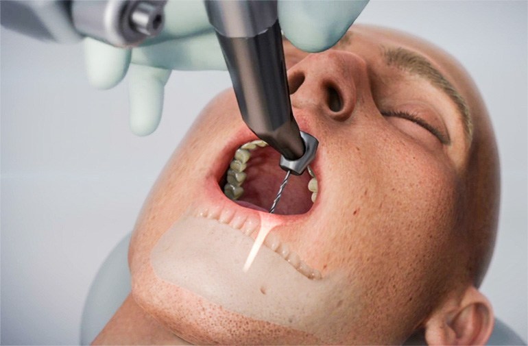Robô realizou cirurgia dentária automatizada na China sem intervenção humana